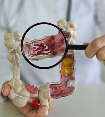 Colon Cancer treatment in Thane