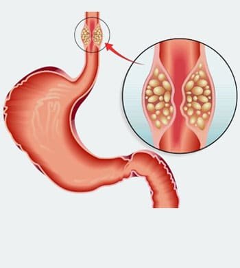 Esophageal Cancer treatment in Thane