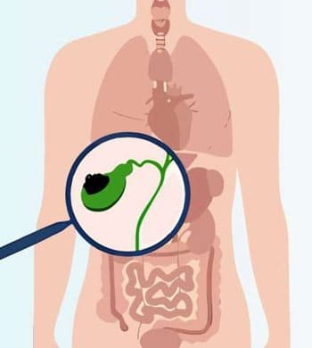Gallbladder Cancer treatment in Thane