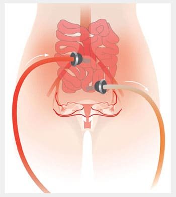 HIPEC Surgery treatment in Thane