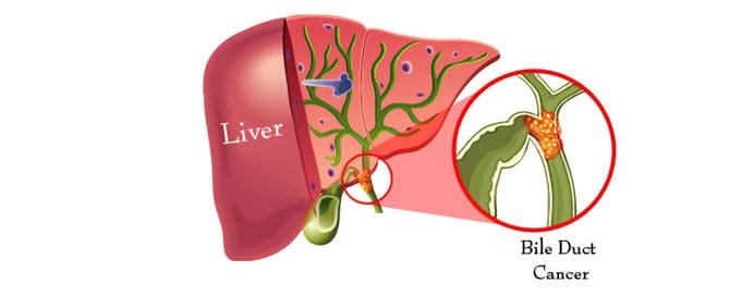 Bile Duct Cancer - Dr. Saneya Pandrowala