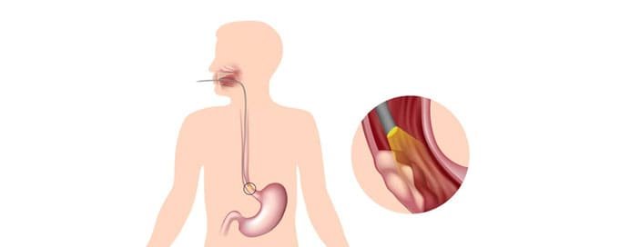 Esophageal Cancer - Dr. Saneya Pandrowala