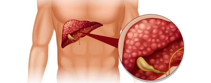 Gallbladder Cancer - Dr. Saneya Pandrowala