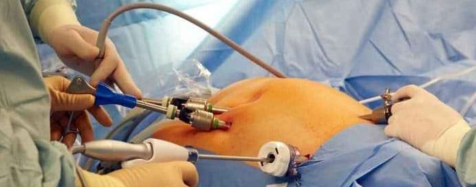 HIPEC Surgery - Dr. Saneya Pandrowala