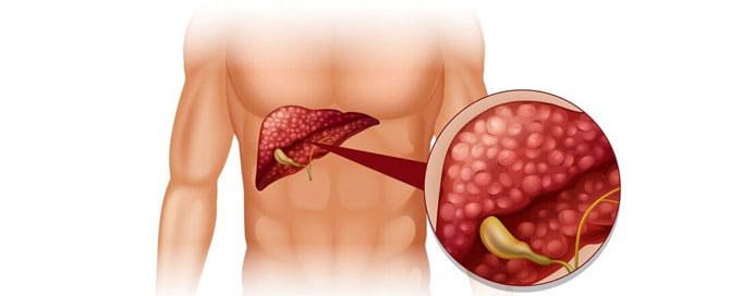 Liver Cancer - Dr. Saneya Pandrowala