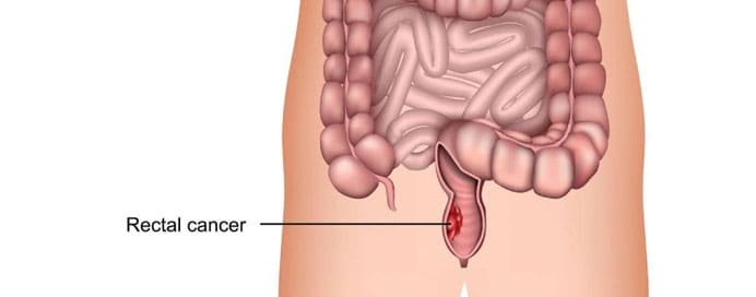 Rectal Cancer - Dr. Saneya Pandrowala