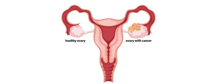 Cervical cancer treatment in Thane by Dr. Saneya Pandrowala