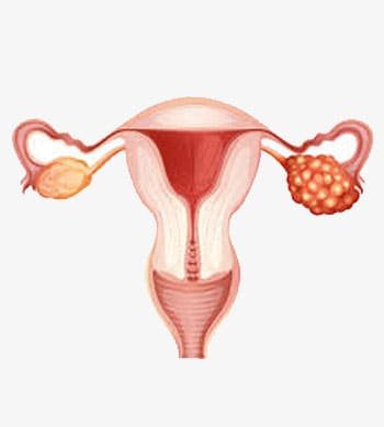 Ovarian Cancer treatment in Thane