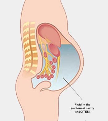 Peritoneal Cancer treatment in Thane