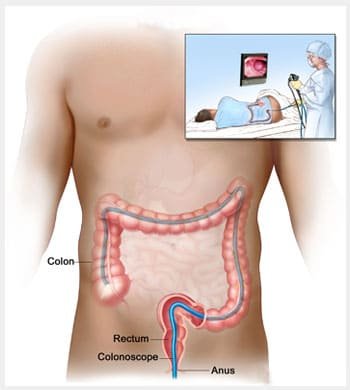 Rectal Cancer treatment in Thane